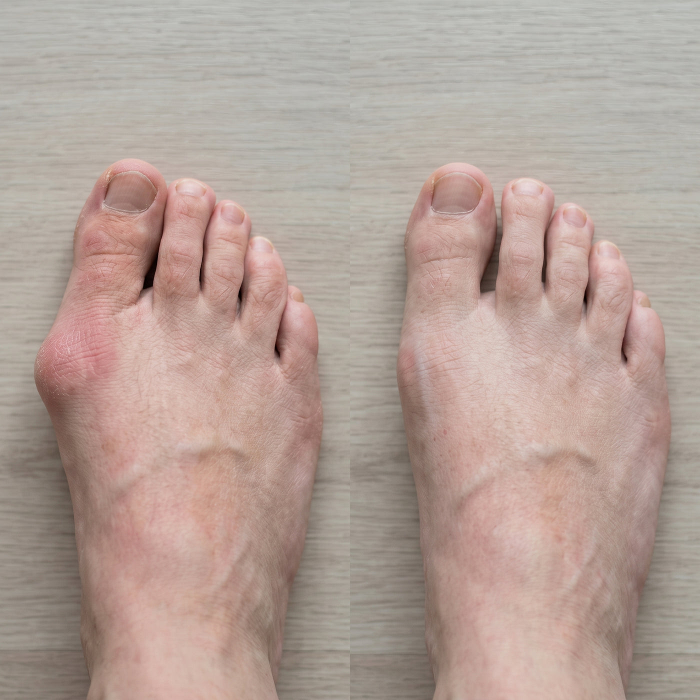 Nightform Bunion Brace
